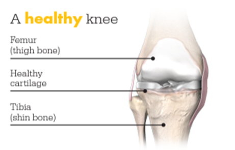 Total Knee Replacement